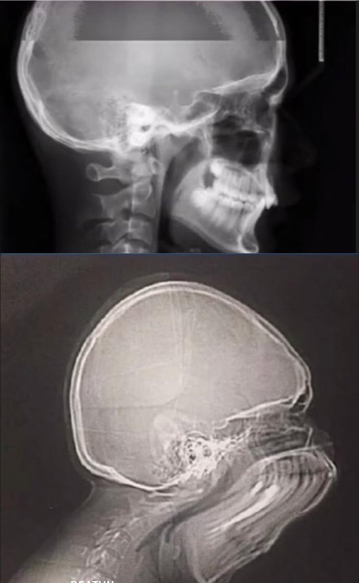 700x1135, 65 Kb / рентген, череп, чихнул, ч/б