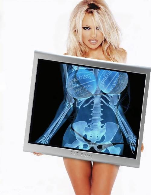 500x645, 37 Kb / рентген, Памела Андерсон, Pamela Anderson, снимок